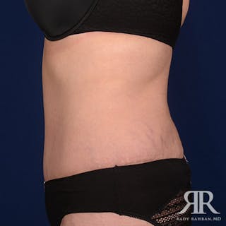 Tummy Tuck Before & After Gallery - Patient 133394 - Image 6