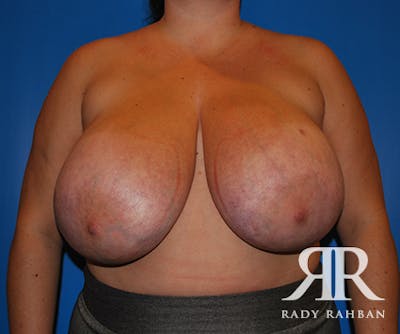 Breast Reduction Before & After Gallery - Patient 247769 - Image 1
