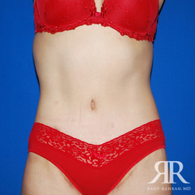 Body Lift Before & After Gallery - Patient 118584 - Image 2