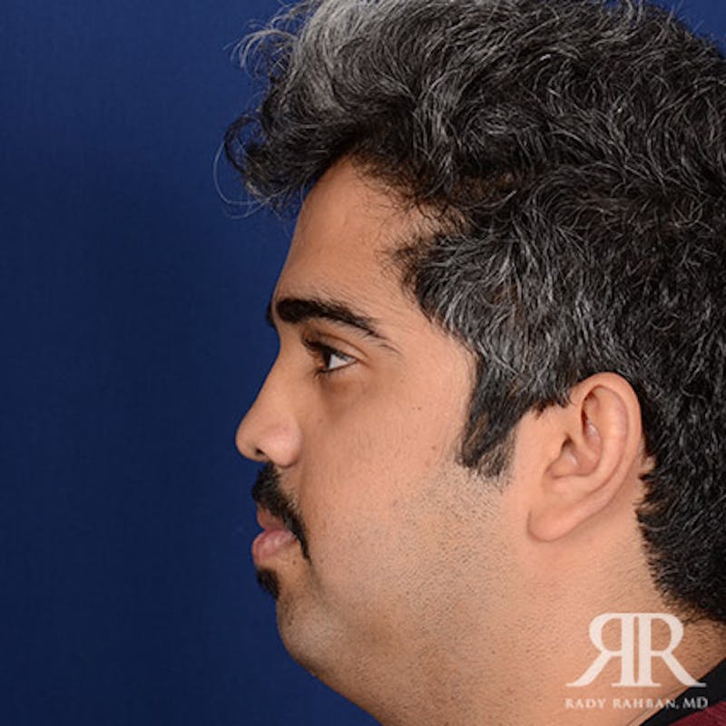 Rhinoplasty w/ Chin Implant Before & After Gallery - Patient 156274 - Image 5