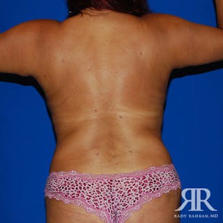 Liposuction Before & After Gallery - Patient 213870 - Image 4