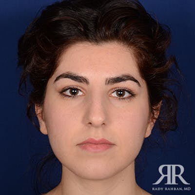 Ethnic Rhinoplasty Before & After Gallery - Patient 230490 - Image 1