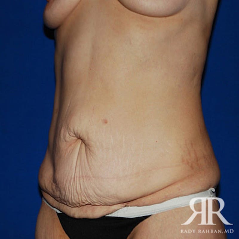 Body Lift Before & After Gallery - Patient 118584 - Image 3
