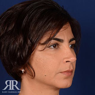Corrective / Revision Rhinoplasty Before & After Gallery - Patient 204579 - Image 4