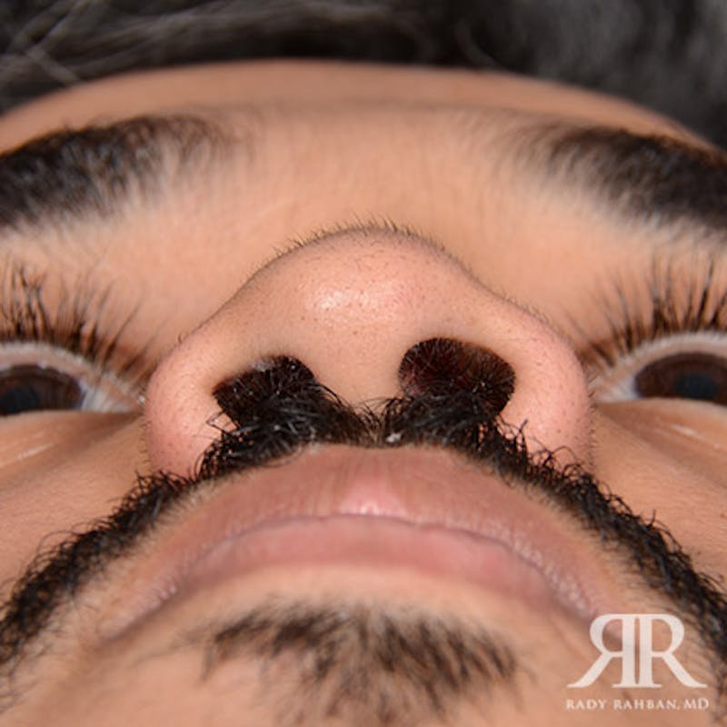 Rhinoplasty w/ Chin Implant Before & After Gallery - Patient 156274 - Image 7