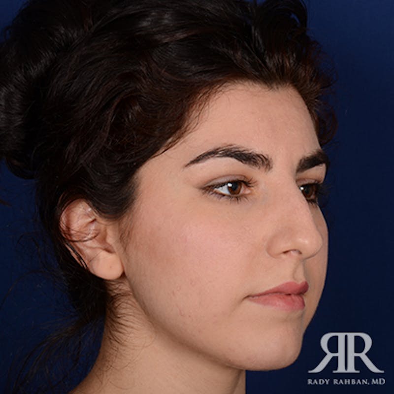Ethnic Rhinoplasty Before & After Gallery - Patient 230490 - Image 3