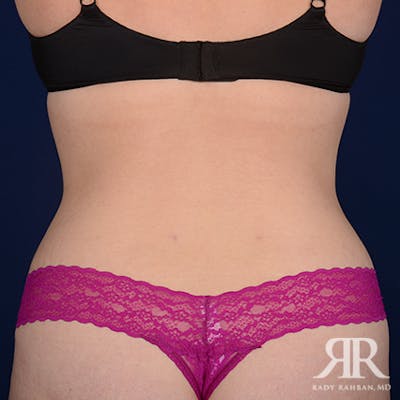 Liposuction Before & After Gallery - Patient 389095 - Image 2