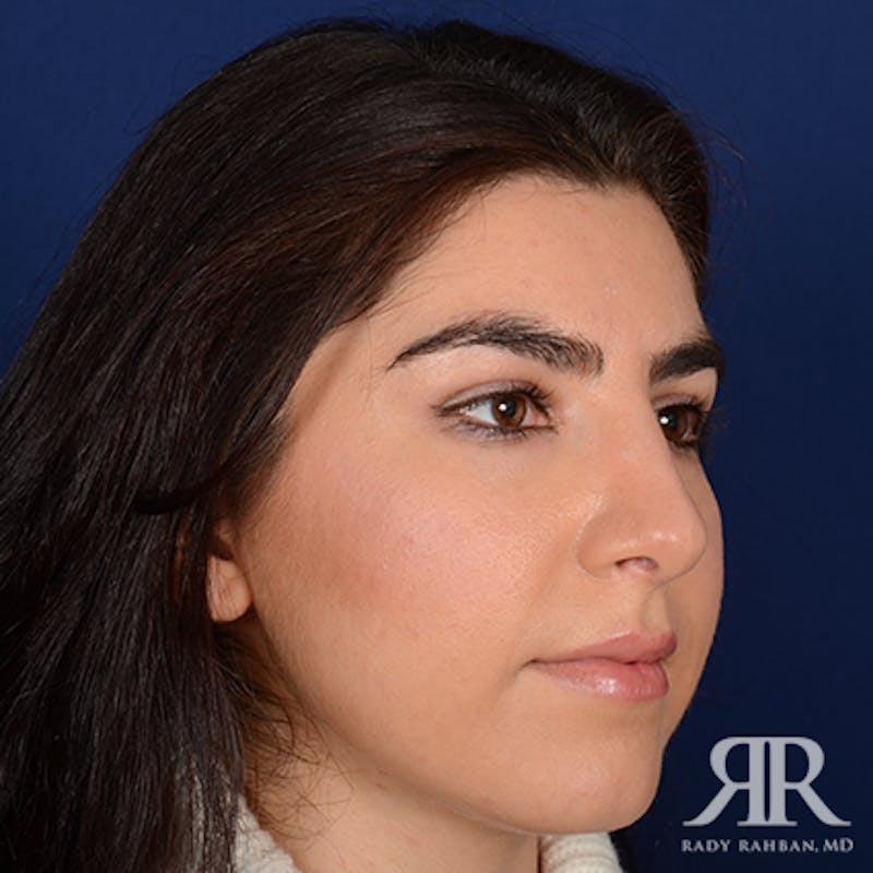 Ethnic Rhinoplasty Before & After Gallery - Patient 230490 - Image 4