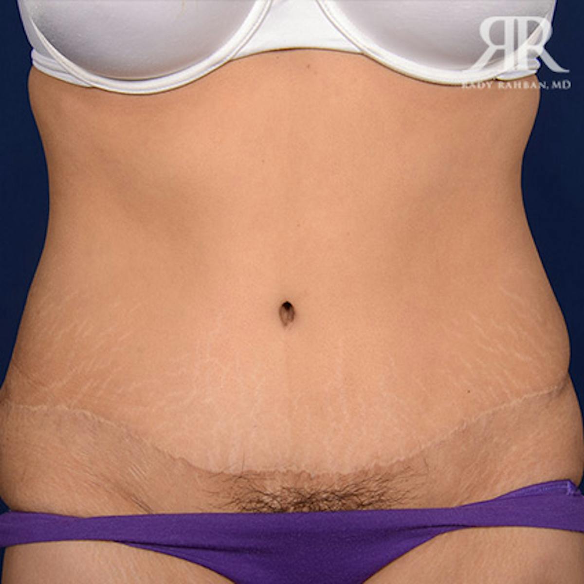 Tummy Tuck Scars Before & After Gallery - Patient 321348 - Image 1