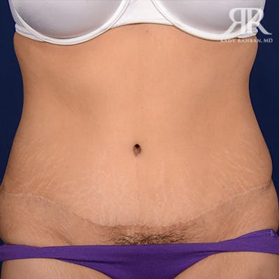 Tummy Tuck Scars Before & After Gallery - Patient 321348 - Image 1