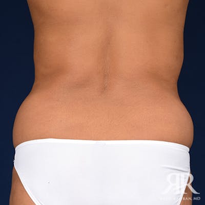 Liposuction Before & After Gallery - Patient 348095 - Image 1