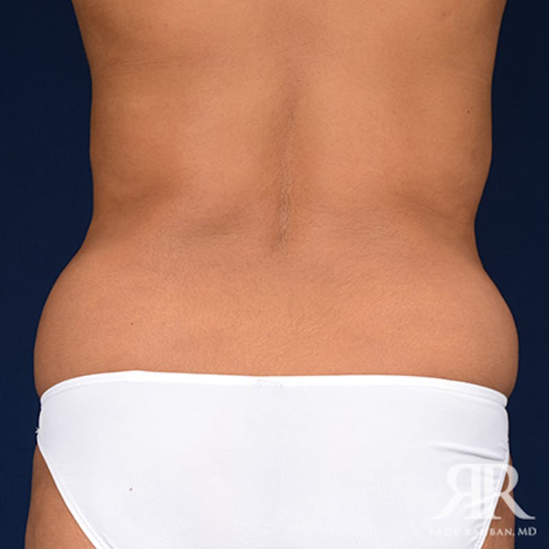 Liposuction Before & After Gallery - Patient 348095 - Image 1