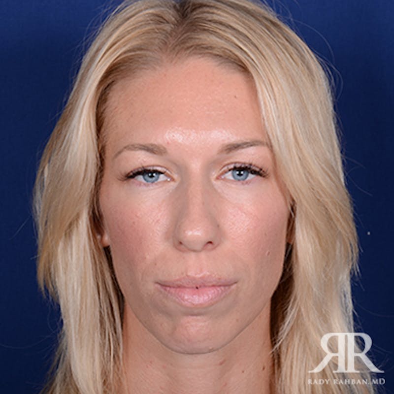 Rhinoplasty w/ Chin Implant Before & After Gallery - Patient 348092 - Image 1
