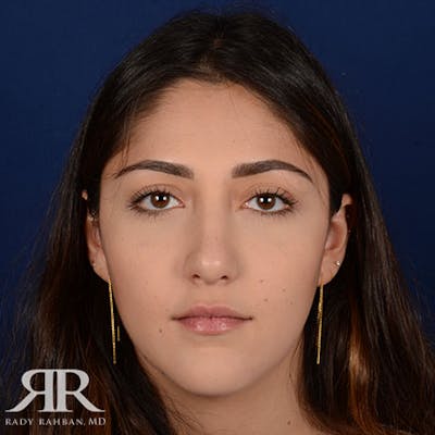 Female Rhinoplasty Before & After Gallery - Patient 252512 - Image 2
