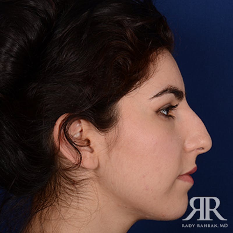 Ethnic Rhinoplasty Before & After Gallery - Patient 230490 - Image 5