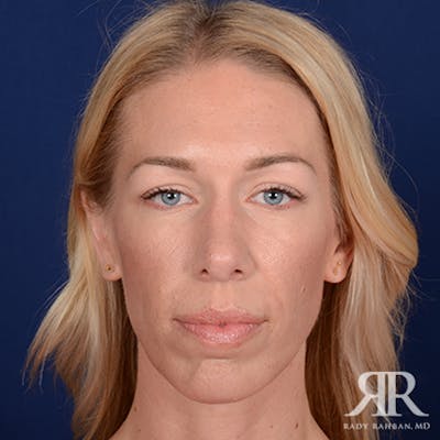 Rhinoplasty w/ Chin Implant Before & After Gallery - Patient 348092 - Image 2
