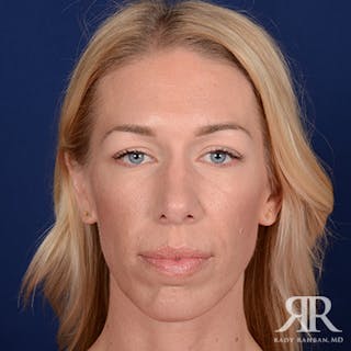 Rhinoplasty w/ Chin Implant Before & After Gallery - Patient 348092 - Image 2