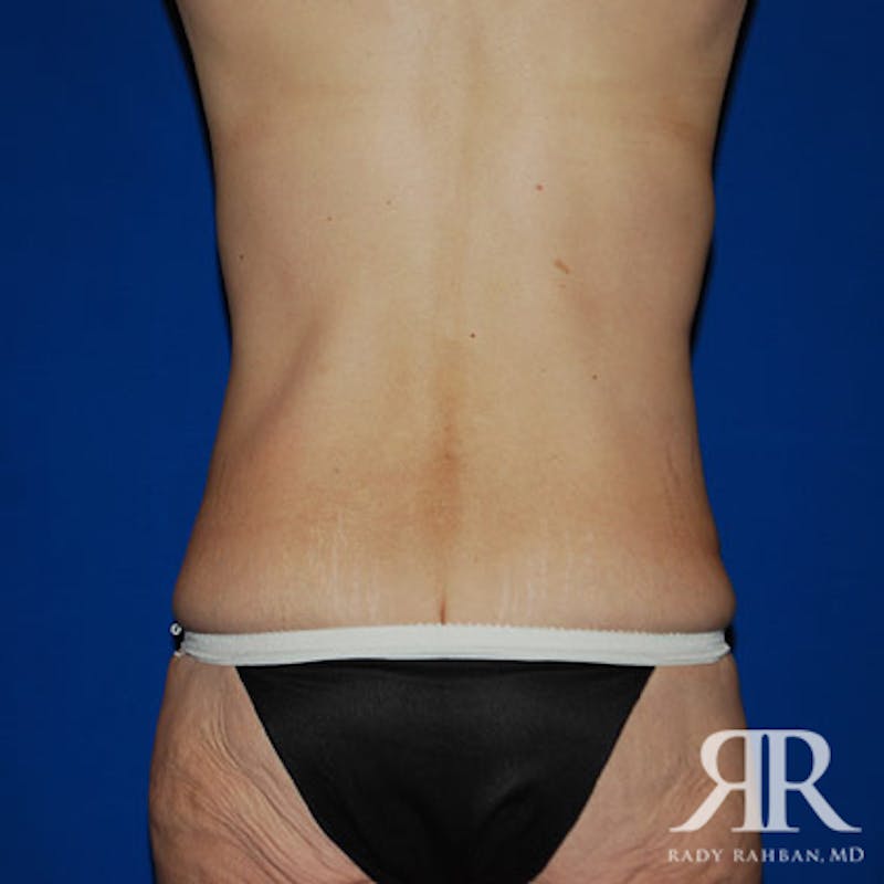 Body Lift Before & After Gallery - Patient 118584 - Image 7