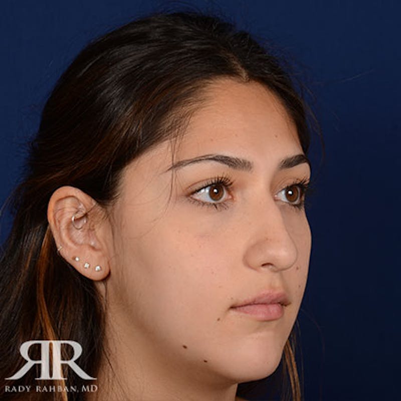 Female Rhinoplasty Before & After Gallery - Patient 252512 - Image 3