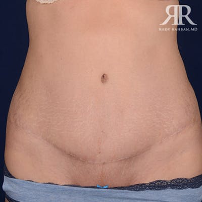Tummy Tuck Scars Before & After Gallery - Patient 108416 - Image 1