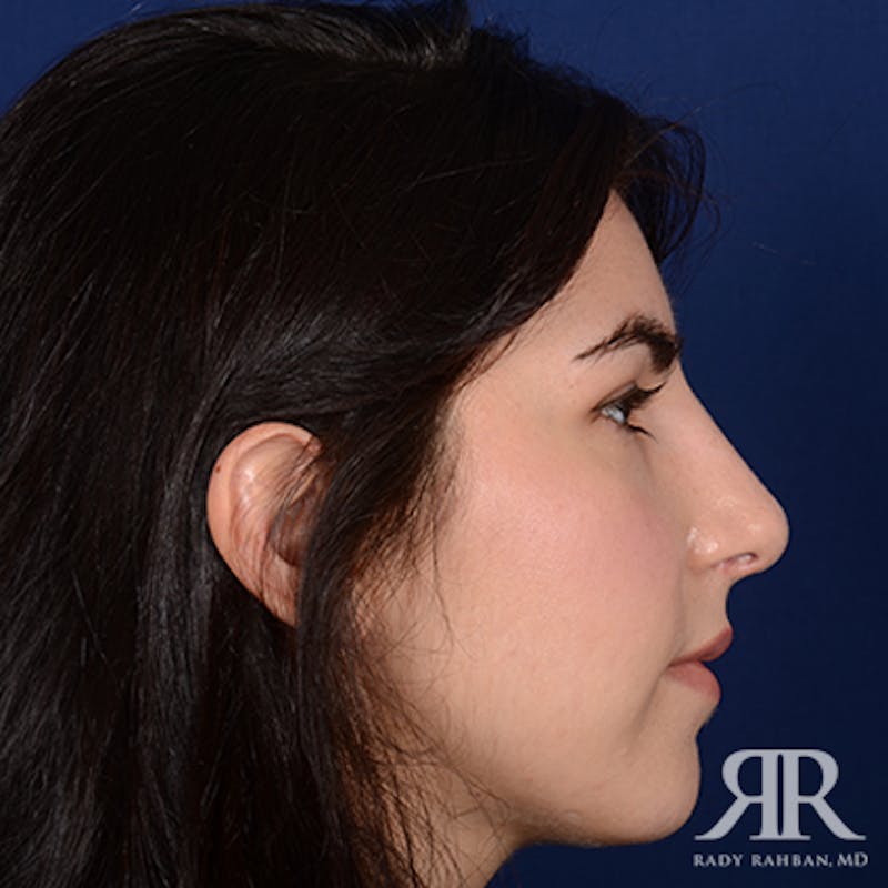 Ethnic Rhinoplasty Before & After Gallery - Patient 230490 - Image 6