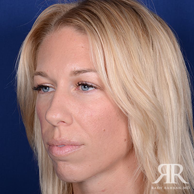 Rhinoplasty w/ Chin Implant Before & After Gallery - Patient 348092 - Image 3