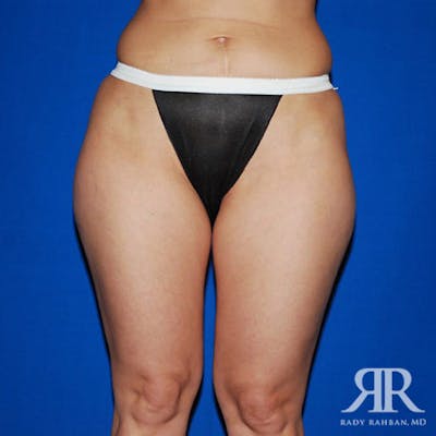 Liposuction Before & After Gallery - Patient 293306 - Image 1