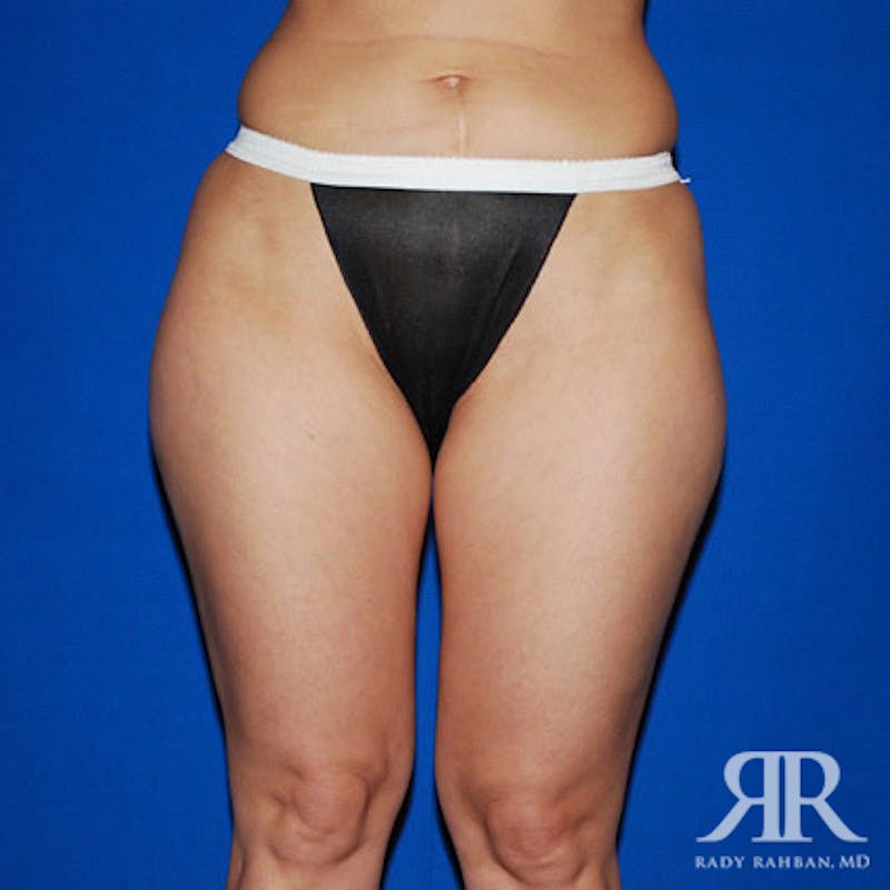 Liposuction Before & After Gallery - Patient 293306 - Image 1