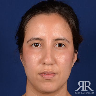 Corrective / Revision Rhinoplasty Before & After Gallery - Patient 259315 - Image 1