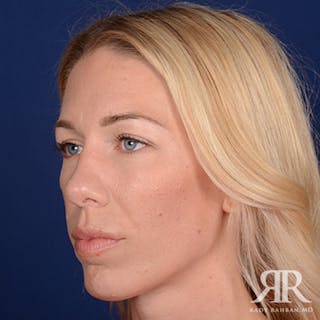 Rhinoplasty w/ Chin Implant Before & After Gallery - Patient 348092 - Image 4