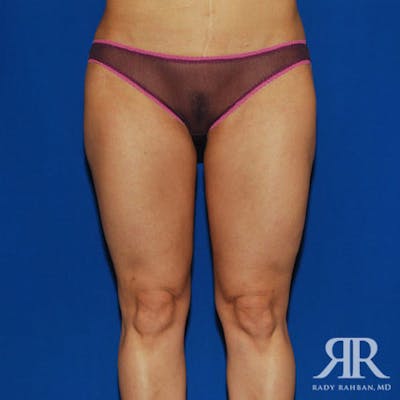 Liposuction Before & After Gallery - Patient 293306 - Image 2