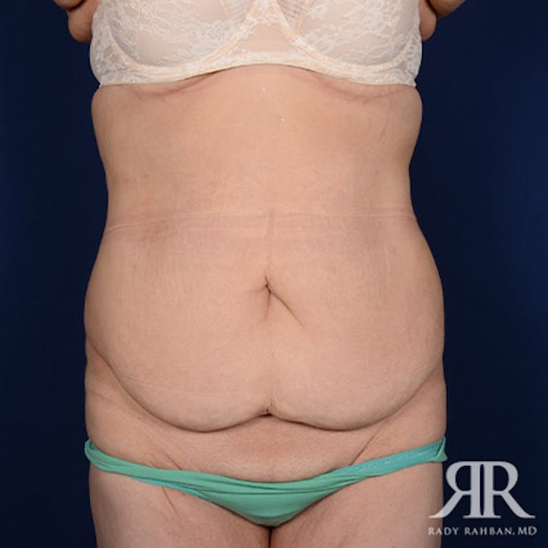 Body Lift Before & After Gallery - Patient 142772 - Image 1