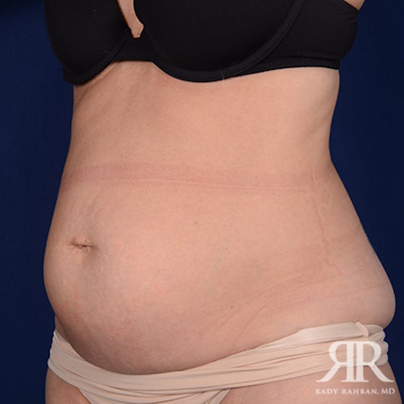 Tummy Tuck Before & After Gallery - Patient 226233 - Image 3