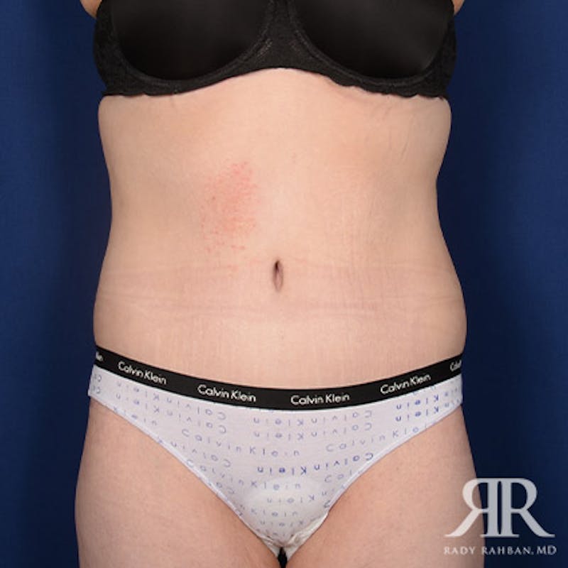 Body Lift Before & After Gallery - Patient 142772 - Image 2