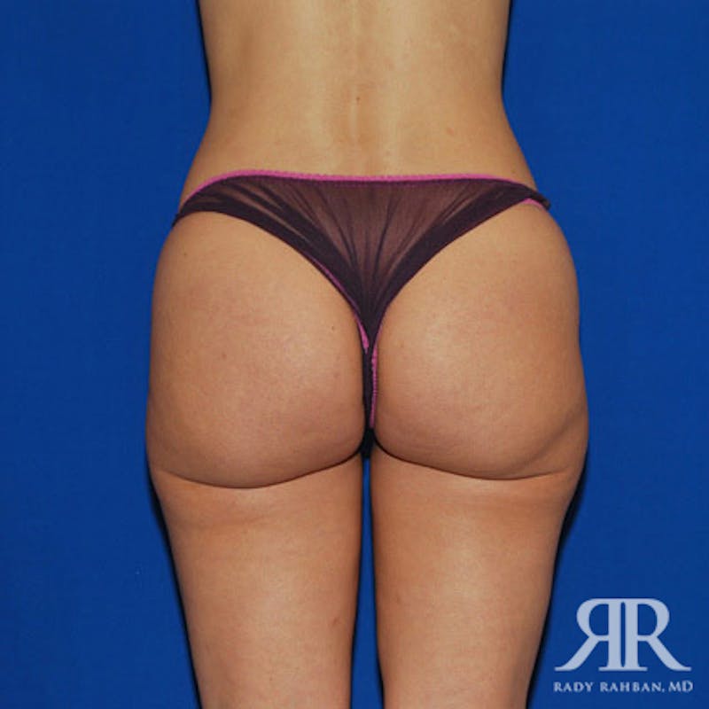 Liposuction Before & After Gallery - Patient 293306 - Image 4