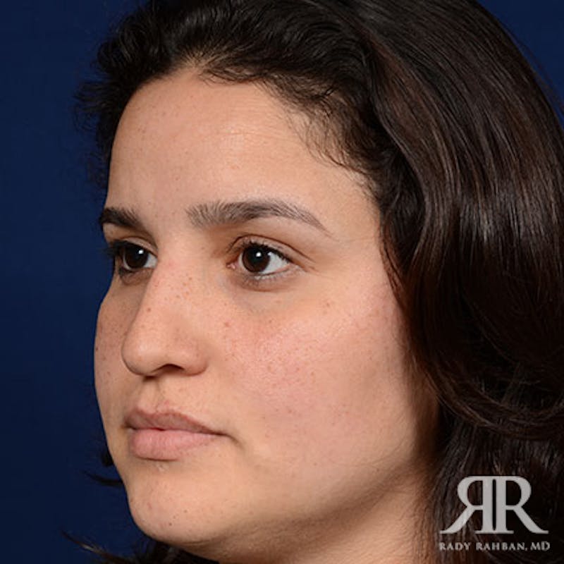 Ethnic Rhinoplasty Before & After Gallery - Patient 298426 - Image 3