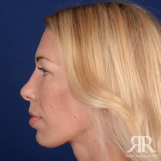 Rhinoplasty w/ Chin Implant Before & After Gallery - Patient 348092 - Image 6