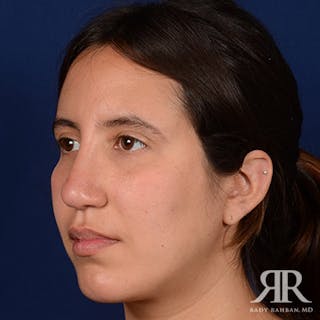 Corrective / Revision Rhinoplasty Before & After Gallery - Patient 259315 - Image 4