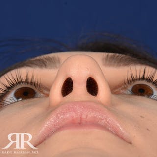 Female Rhinoplasty Before & After Gallery - Patient 252512 - Image 8