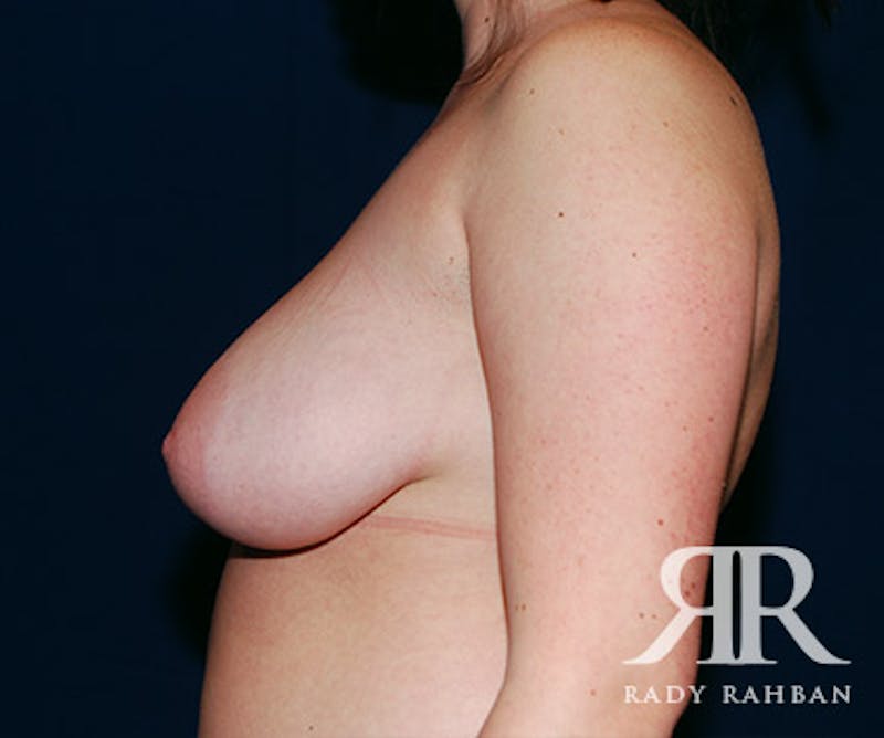 Breast Reduction Before & After Gallery - Patient 201039 - Image 5