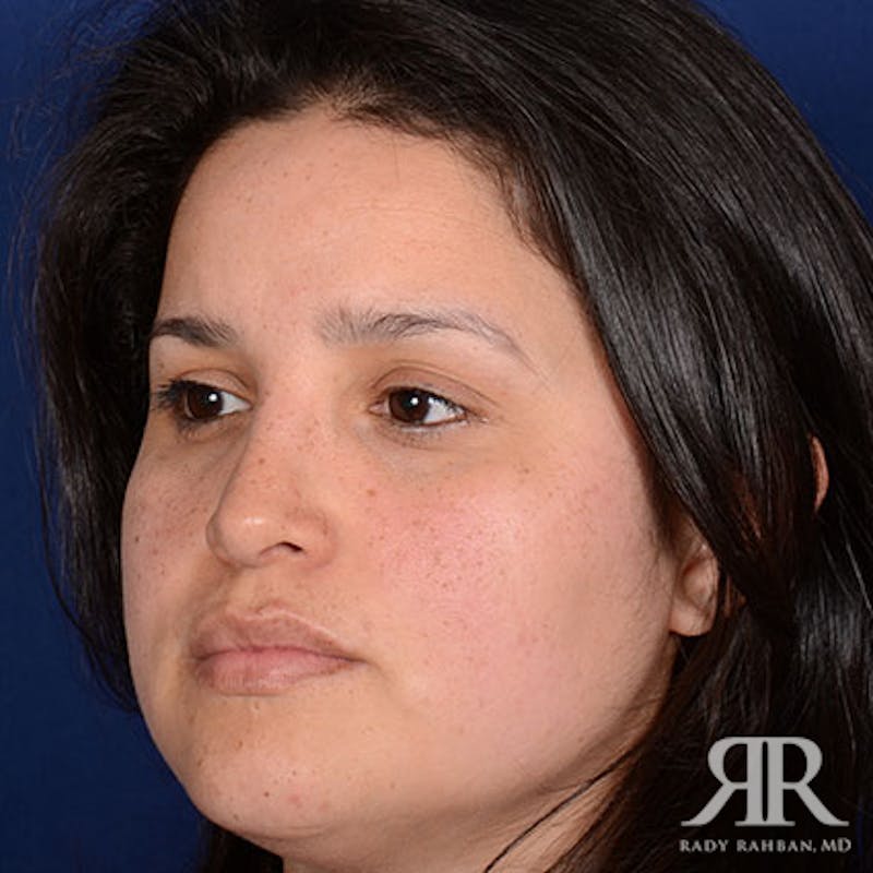Ethnic Rhinoplasty Before & After Gallery - Patient 298426 - Image 4