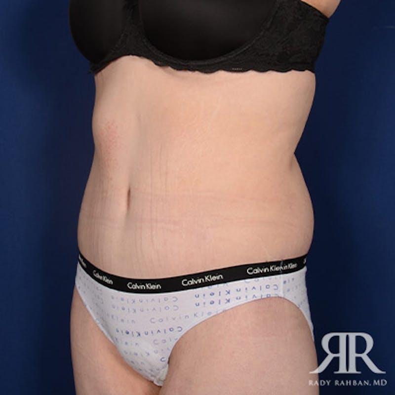 Body Lift Before & After Gallery - Patient 142772 - Image 4
