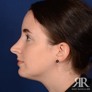 Chin Augmentation Before & After Gallery - Patient 294299 - Image 6