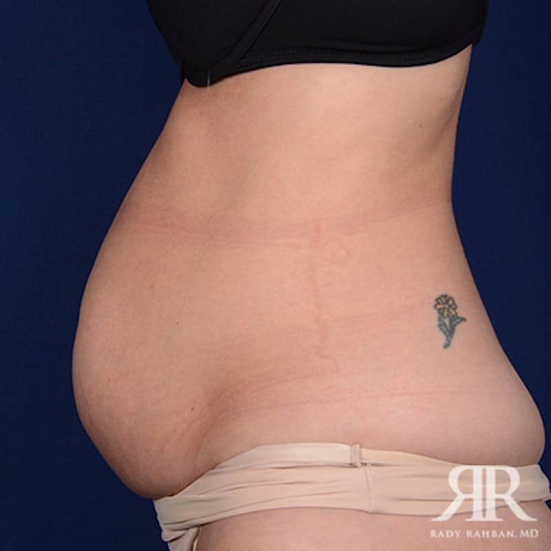 Tummy Tuck Before & After Gallery - Patient 226233 - Image 5
