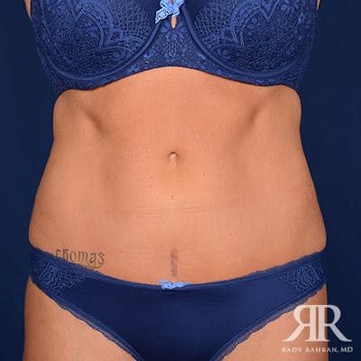 Severe Diastasis Recti Before & After Gallery - Patient 378045 - Image 2