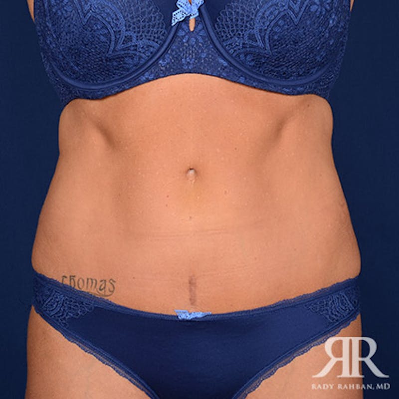 Severe Diastasis Recti Before & After Gallery - Patient 378045 - Image 2