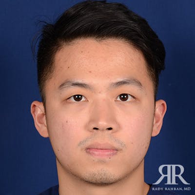 Chin Augmentation Before & After Gallery - Patient 274657 - Image 1