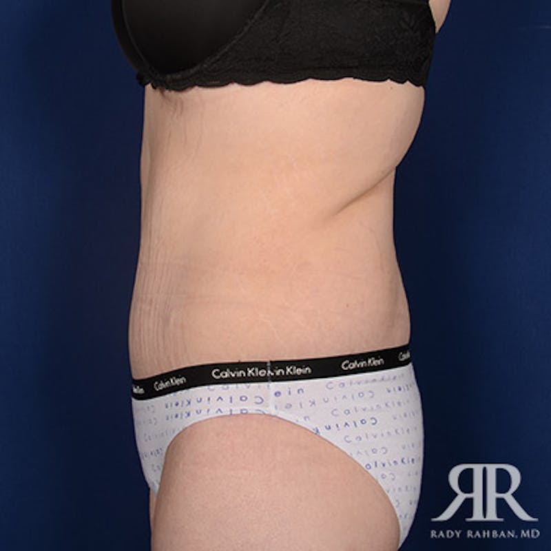 Body Lift Before & After Gallery - Patient 142772 - Image 6