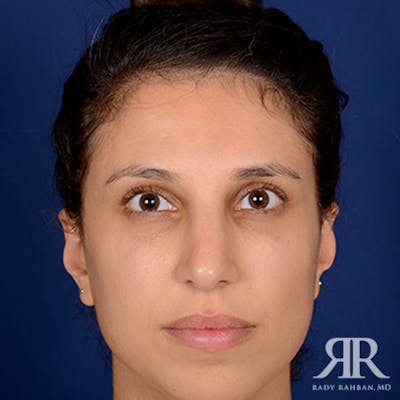 Female Rhinoplasty Before & After Gallery - Patient 180163 - Image 2