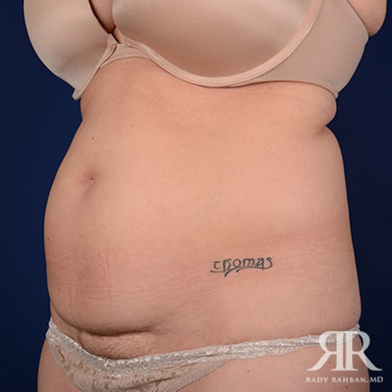 Severe Diastasis Recti Before & After Gallery - Patient 378045 - Image 3